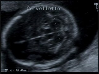 Sistema nervoso centrale ecografia strutturale ostetrica