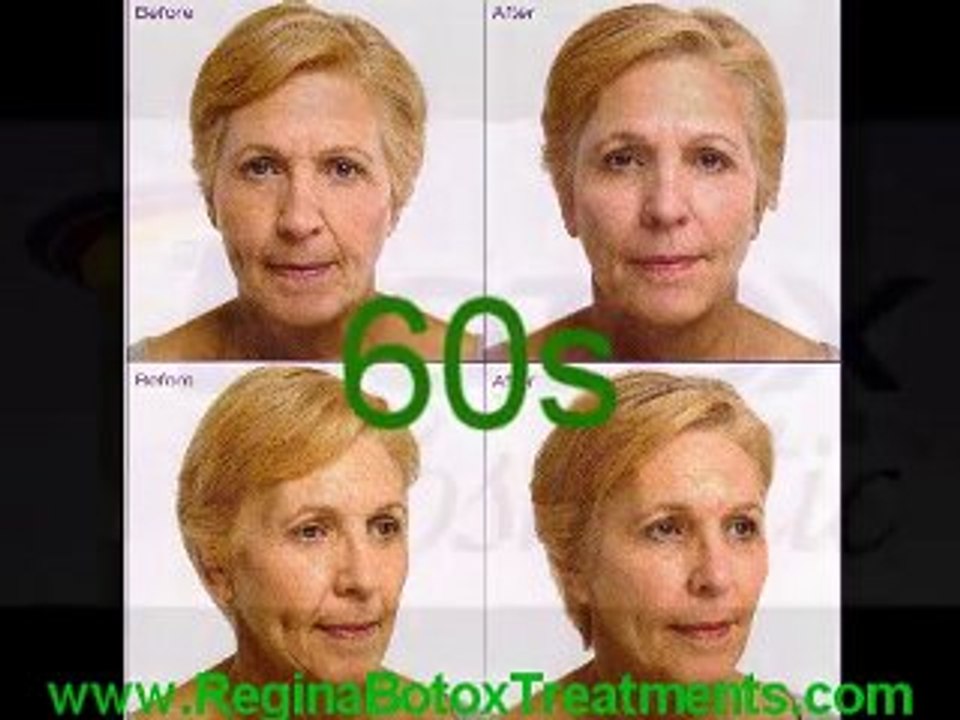 Botox Treatments for a Beautifuk look