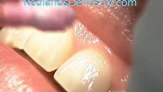 Redlands Dentist Fixes Gummy Smile in Minutes