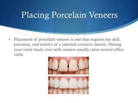 Creating A Beautiful Smile with Porcelain Veneers
