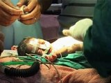 Doctors successfully separate conjoined twins