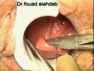 عملية البواسير بالتدبيس-1