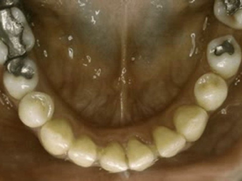 Aralıklı dişlerin tedavisi