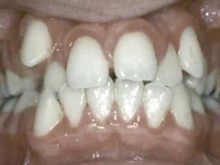 Çekimli Tedavi (ön görünüm)