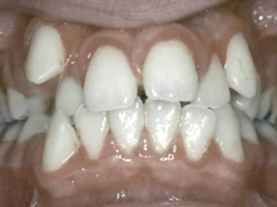 Çekimli Tedavi (ön görünüm)