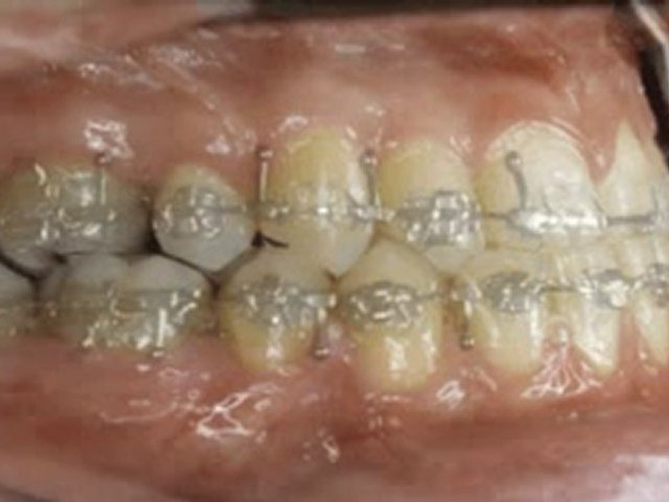 İskeletsel Sınıf 3 anomali