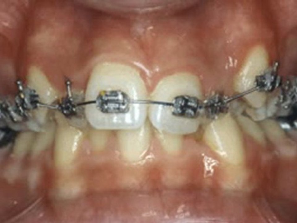 Nikel-titanyum ark tellerinin çalışma simulasyonu