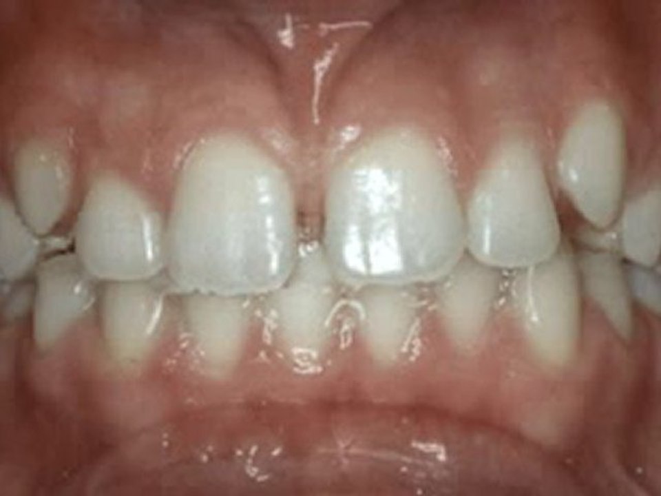 Santral diastema (ön aralık dişler)