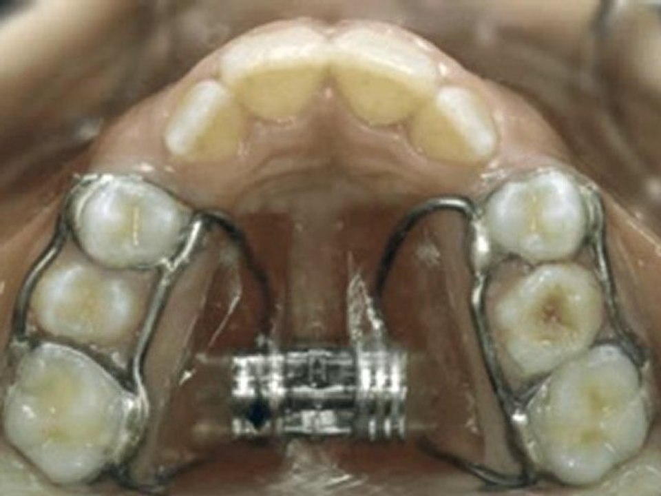 Hızlı üst çene genişletilmesi