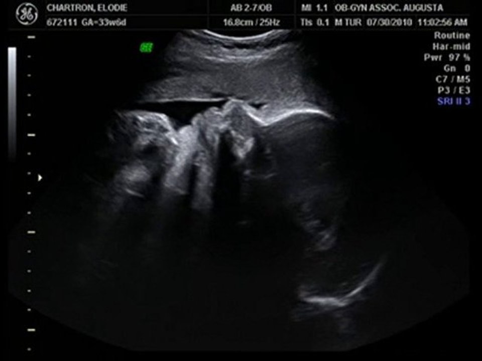 Plus que 6 semaines pour voir le bout de son nez - 3ème écho