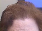 Female Hair Transplant Close Up for Female Pattern Baldness