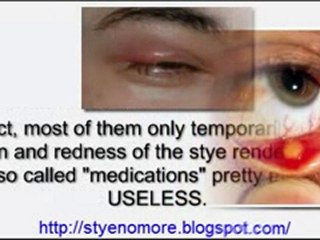 Stye Treatment - Stye No More! Get Rid of Eye Styes Easily