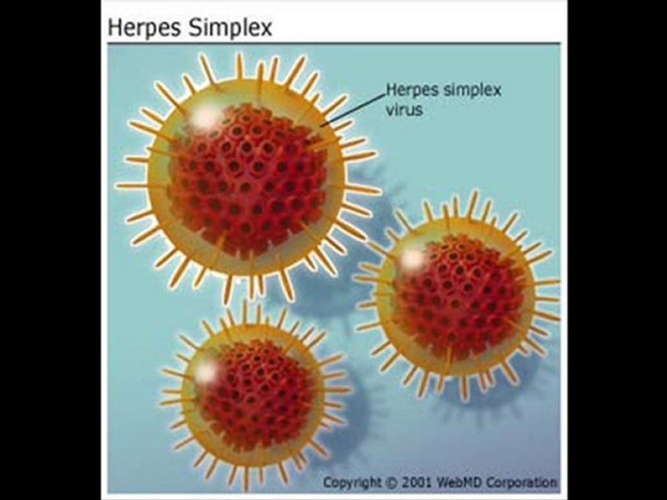 Descubra Como Curar Su Herpes Rapida y Eficazmente