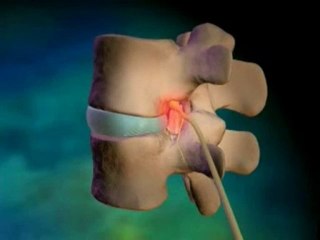 Spinal fusion surgery: Medical Tourism