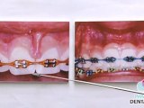 Denver Periodontist - Braces, Orthodontics, And Your Gums