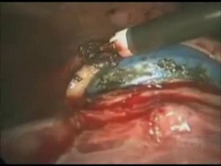 Total Laparoscopic Hysterectomy