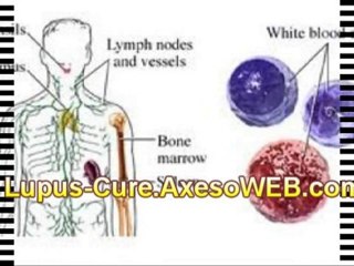 Lupus lupus - Cure Lupus Simple Step Reverse Lupus Condition