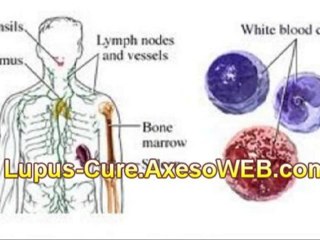 Скачать видео: Lupus-Breakthrough ☺ Cure Lupus Step by Step