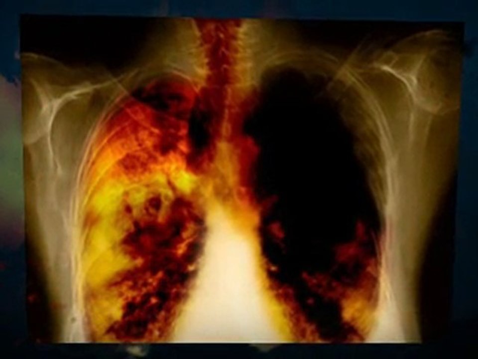 Asbestos Removal Wellington 561 FL