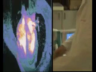 ATV Haber lazer kansız by-pass Dr. Cafer Abbasoğlu