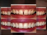 Beverly Hills, Ca Porcelain Veneers (866) 380-0023