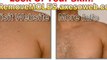 End Skin Tags in 3 Days - Guide Step by Step End Skin Tags