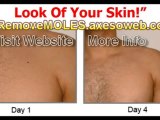 LEARN at Home HOW Remove Moles Warts & Skin Tags In 3 Days #
