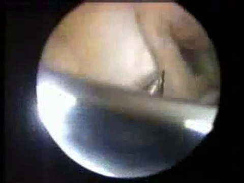 Ön Çapraz Bağ Ameliyatı