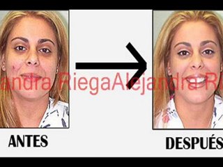 Solución Definitiva Para Eliminar el Acné