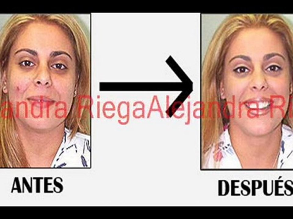 Solución Definitiva Para Eliminar el Acné