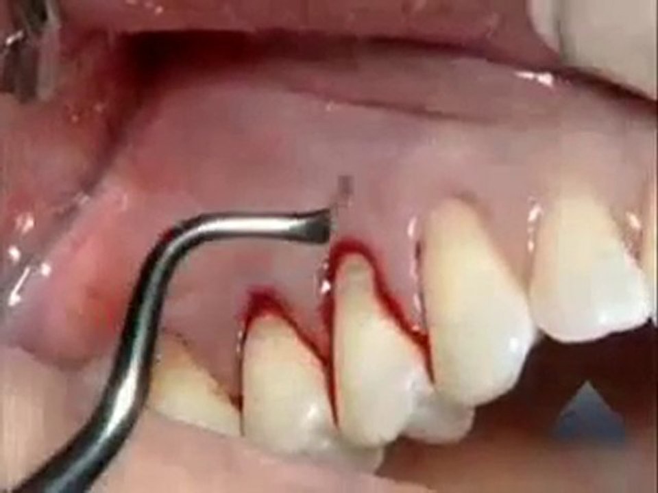 Alloderm greftle koronale poziyon.flv