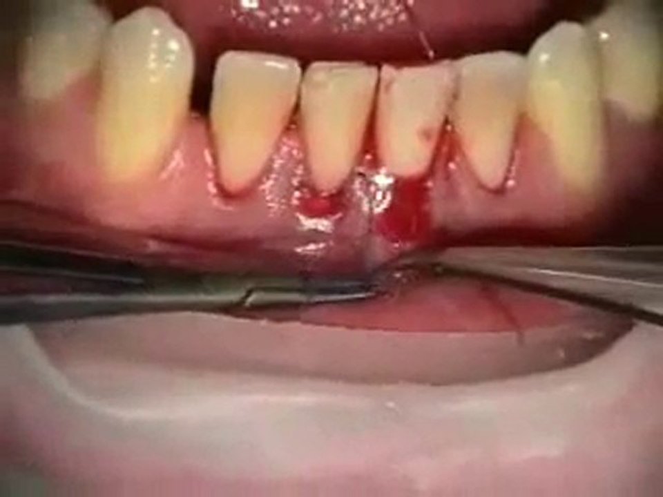 Allodermle kök kapatma.flv
