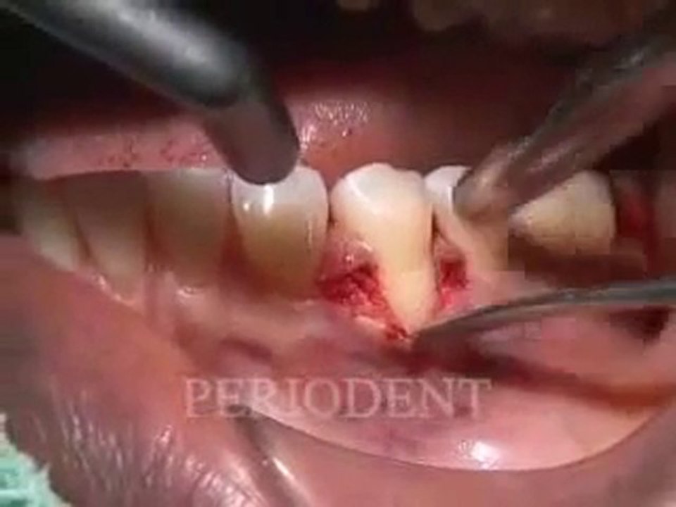 Emdogain ve bağdokusu ile kök kapatma.flv