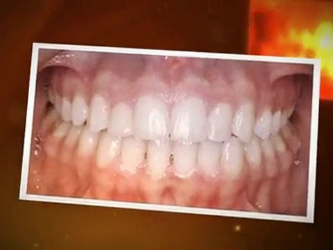 Orthodontics Fort Collins - See What Braces Can Do For You!