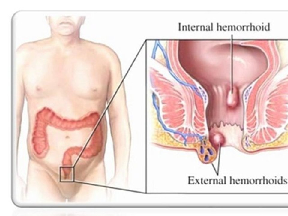 Hemorroides Tratamiento - Como Curar las Hemorroides NOVEDOS