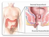 Como Curar las Hemorroides - Hemorroides Tratamiento - Hemor