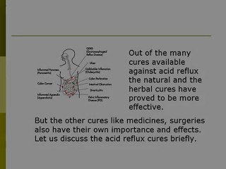 Acid Reflux Cures