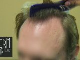 FUE Hair Restoration results - Follicular Unit Extraction