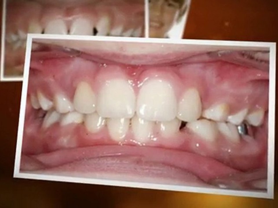 Orthodontist in Westminster - Start Your New Smile Today!