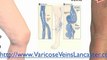 Best Varicose Veins Trearment Lancaster, Varicose Vein Remo