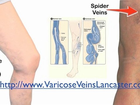 Best Varicose Veins Trearment Lancaster, Varicose Vein Remo