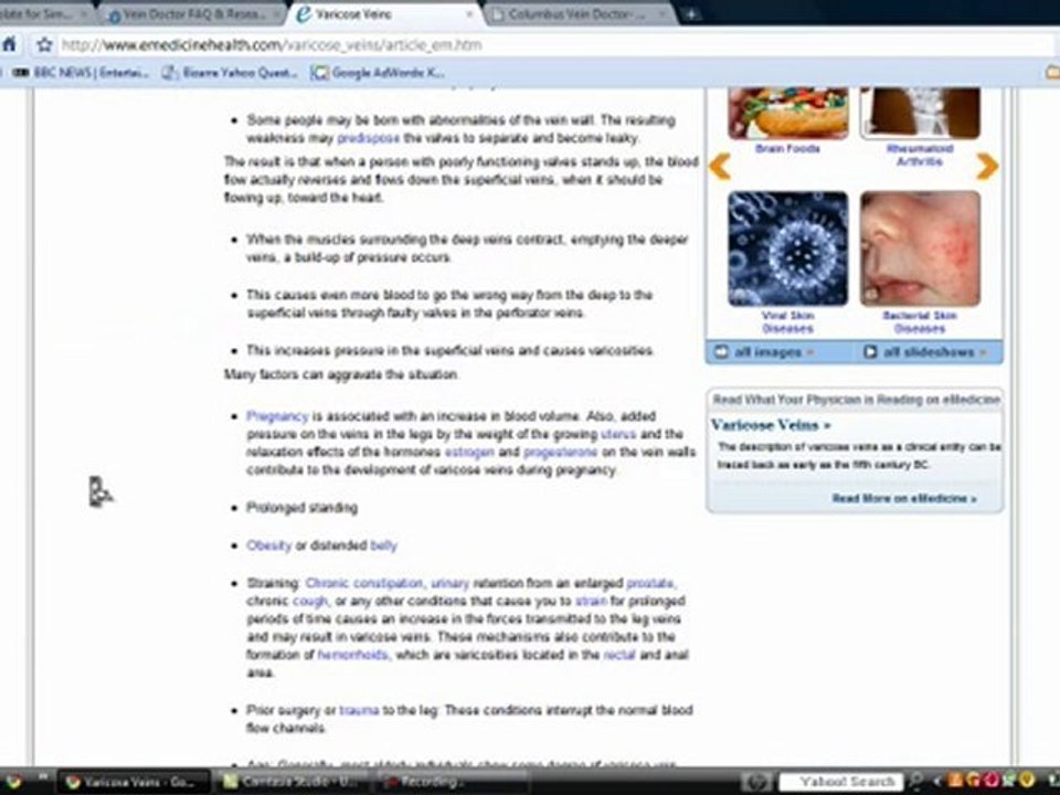 Varicose Vein Doctor Consultations and Information
