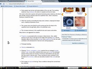 Varicose Vein Doctor Consultations and Information