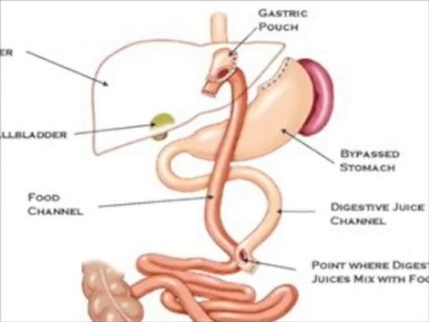 Obesity Solutions International Weight Loss Surgery