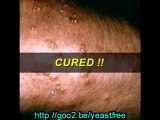 Cure Your Yeast Infection Guaranteed - Learn how to cure you
