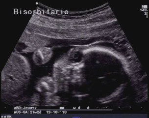 Arnold chiari di tipo I