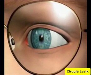 Cirugía Miopia en El Salvador, Laser, Corrección de Vision