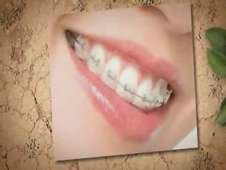 Dentists Fairfax Va:Do I Need Braces