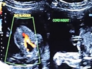 Baby Boy Deruise (21 Week Ultrasound)