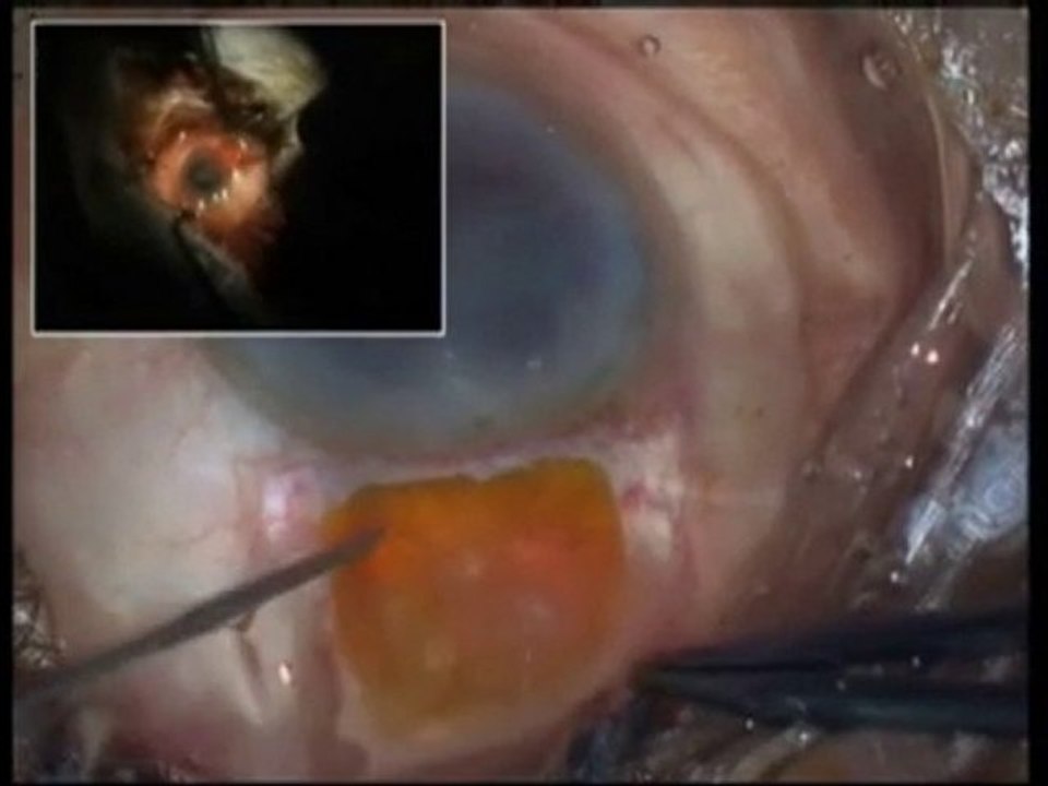 Manual SICS under enhanced topical anesthesia  Dr.NSD Raju